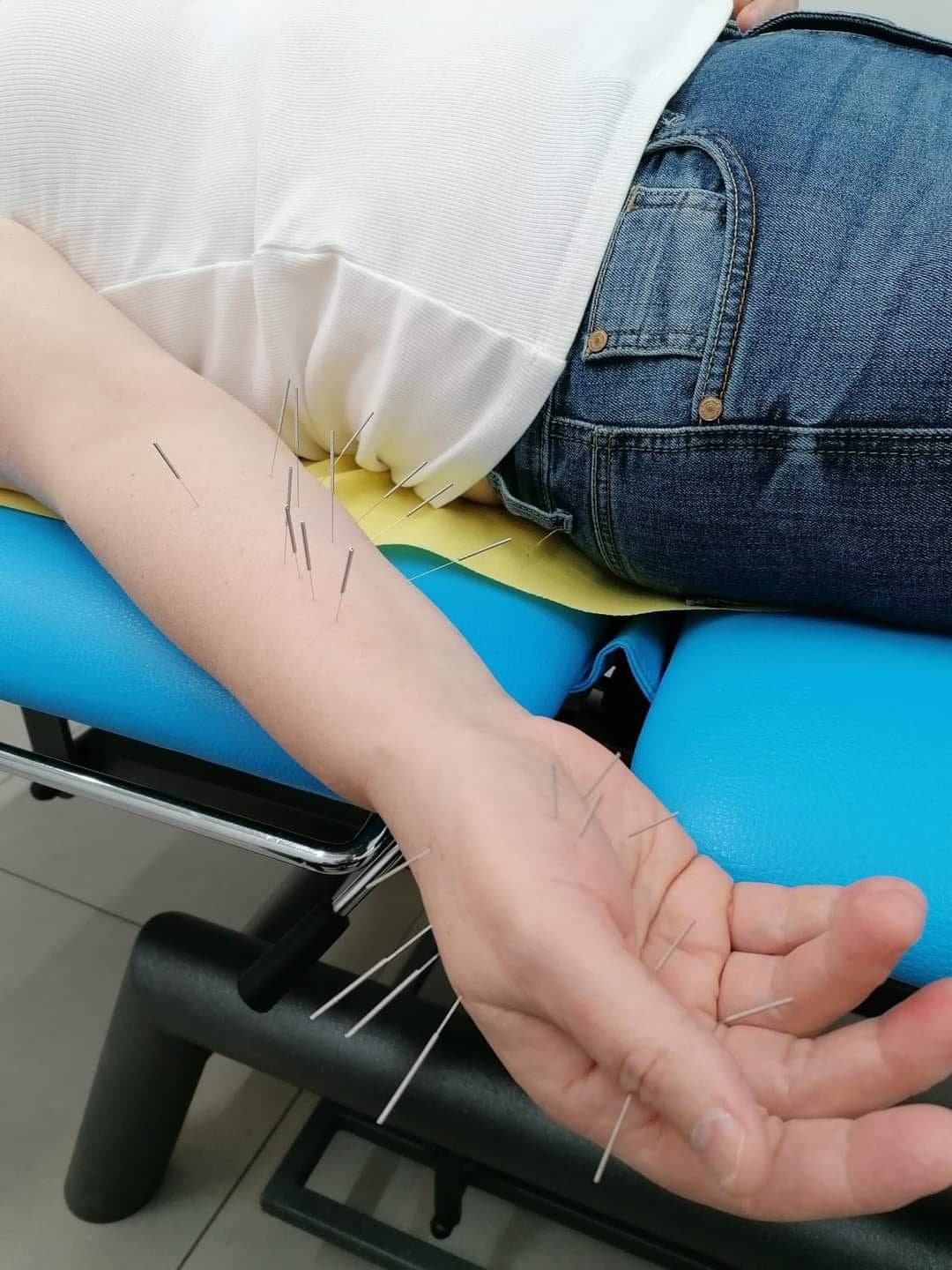 akupunktura-medyczna-leczenie-bolu-przewleklego