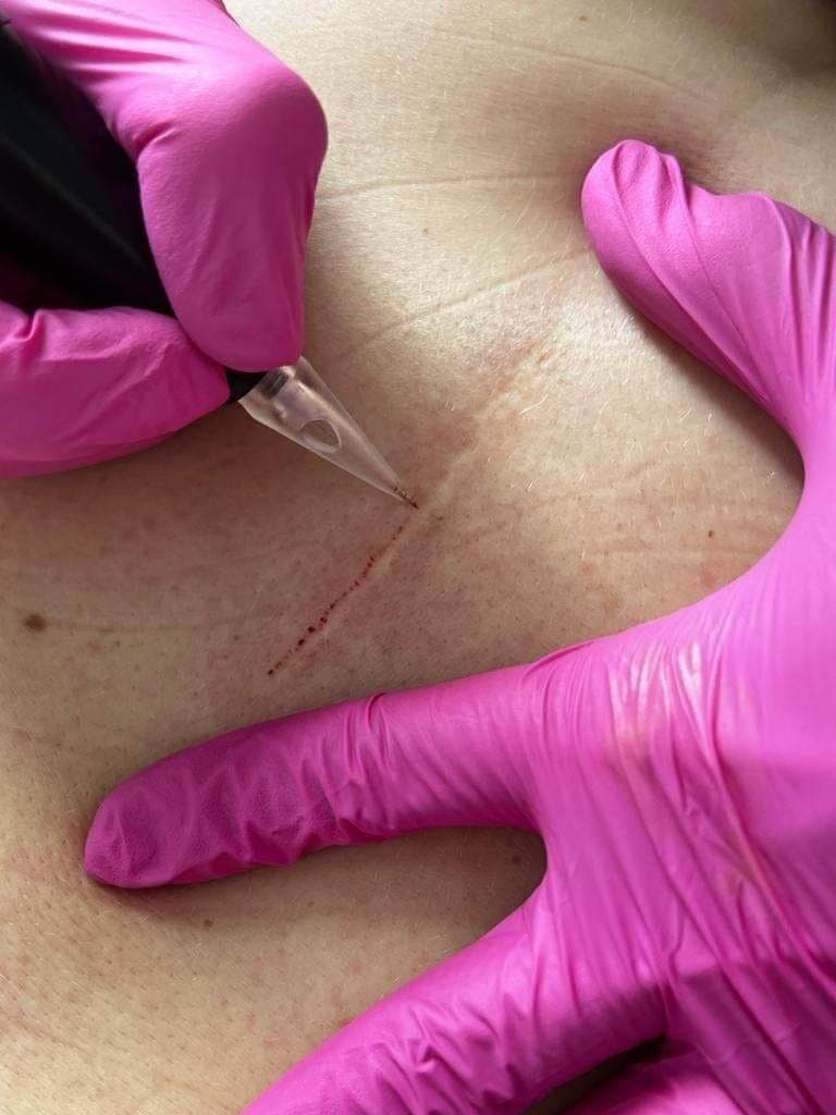 fizjoterapia-blizny-po-cc-uwalnianie-zrostow